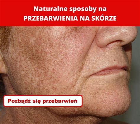 Naturalne sposoby na PRZEBARWIENIA NA SKÓRZE