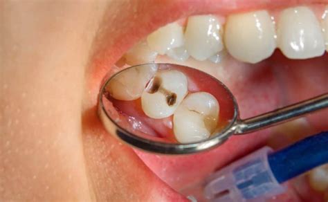 Odontología conservadora Qué es y en qué consiste Clinica FL Dental