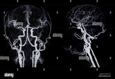 CT Angiographie Des Gehirns Oder CTA Gehirn Mit Darstellung Der A