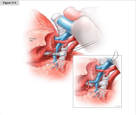 Right Upper Lobectomy Technique