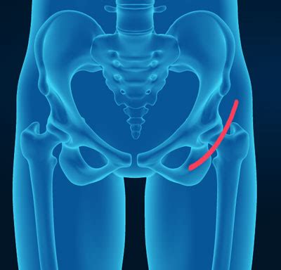 Anterior Approach Hip Replacement Rochester Hills | Hip Dislocation Troy