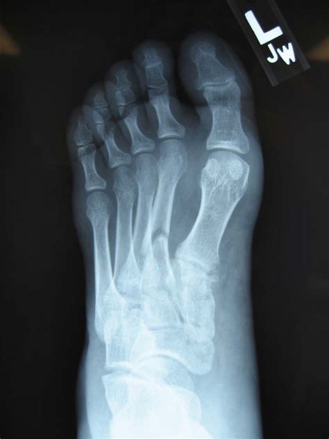 Micro fracture first metatarsal head cpt >> micro fracture first metatarsal head cpt >> broken ...