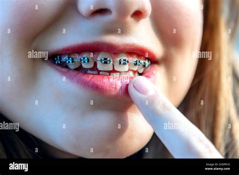 Happy Teenage Girl Pointing On Her Dental Braces Young Teenage Girl