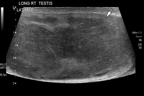 Testicular Seminoma And Its Mimics From The Radiologic Pathology