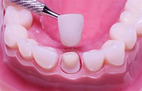 Dental Porcelain Crowns in Phoenix, AZ | Sonoran Hills Dental