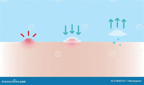 Acne Pimple Patch For Papule Vector Illustration On Blue Background