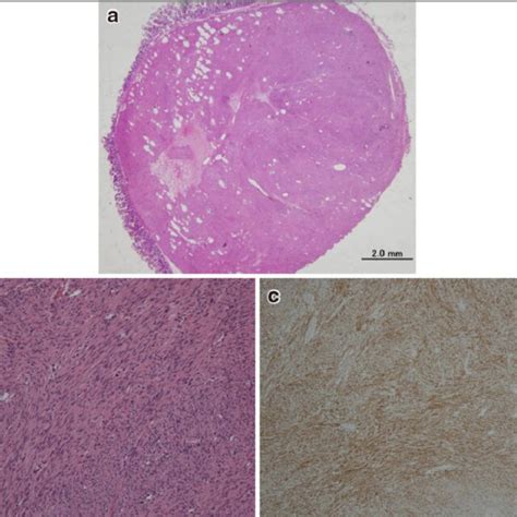 A Loupe Of The Resected Specimen Shows A Submucosal Mm Tumor In The