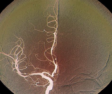 Cerebral Vasculitis X Ray Photograph By Zephyr