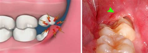 Wisdom tooth extraction or removal surgery treatment Pune, India