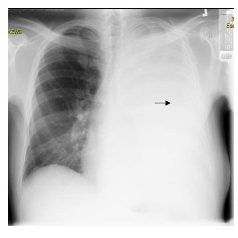 Chest X-ray (PA view): Re-accumulation of massive left sided pleural... | Download Scientific ...