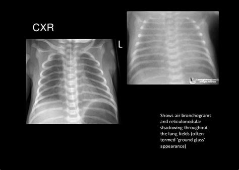 Disorders Of The Respiratory System Respiratory Distress Syndrome