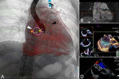 ISMICS First In Man Application Of Triple Fusion Echocardiography