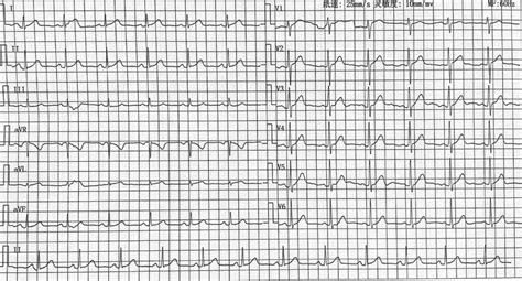 Ecg Showed Normal Sinus Rhythm After Radiofrequency Ablation