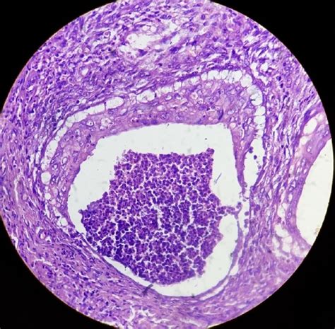 Rectal Polyp Biopsy