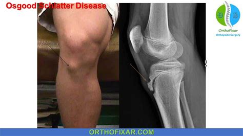 Osgood Schlatter Disease Symptoms