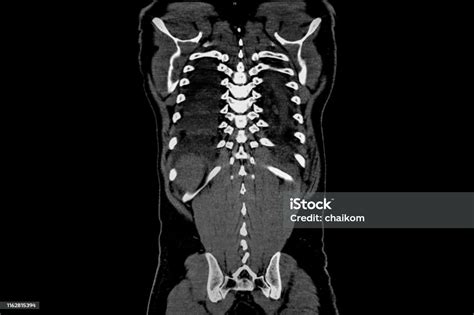 Computer Tomography Angiography Cta Of Whole Body Scan With 3d Reconstruction Ct Angiography For