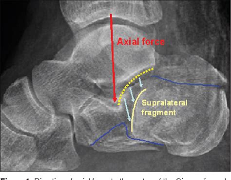 Figure From Operative Treatment Of Intra Articular Calcaneal