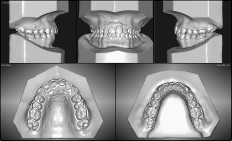 Orthodontic Treatment Of An Ankylosed Maxillary Central Incisor Through Single Tooth Osteotomy