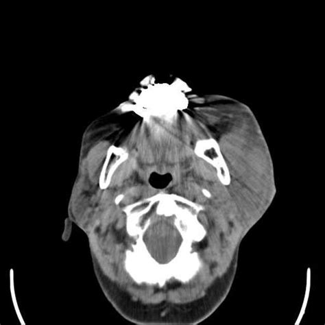 Parotitis CT or MRI - wikidoc