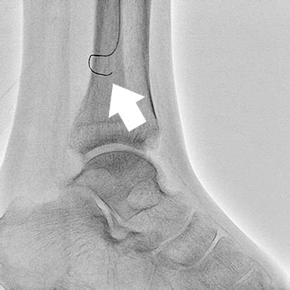 下肢血管腔内治疗方面最大限度地运用Trinias的应用程序 用户体验 Minimally Invasive Experience 岛津医疗