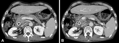 Endoscopic Ultrasound Guided Pancreaticoduodenostomy With A Forward Viewing Echoendoscope Videogie