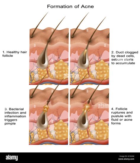 Hair Follicle Infection