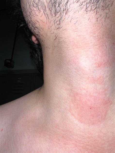 Dry Red Itchy Area Of Neck Went Away Before But Came Back Rdermatology