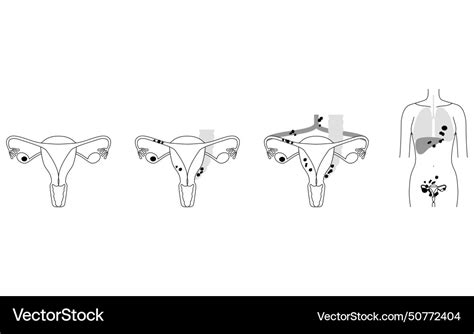 Diagrammatic of stage i ovarian cancer anatomy Vector Image