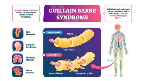 Guillain Barr Syndrome Causes Symptoms Types Treatment And