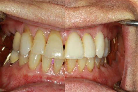 Upper Anterior Rebuild - Barkley Blvd Dental Care