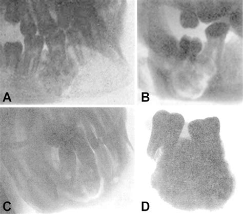 Radiographs Of Cementoblastoma A Blairs Case Published In 1915 44