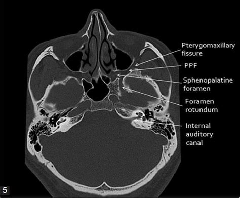 An X Ray Shows The Location Of The Cranium In The Lower Limb