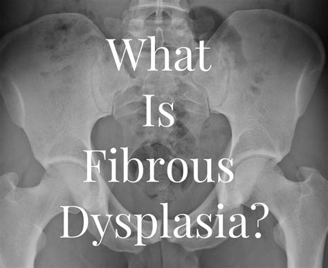My Diagnosis Fibrous Dysplasia Patients Lounge