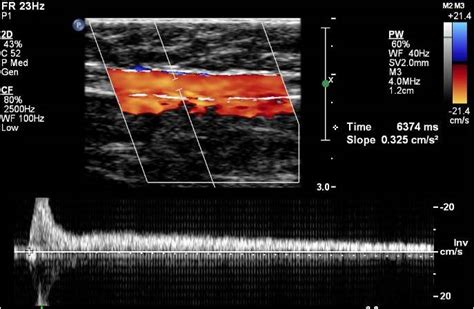 Venous Insufficiency Ultrasound