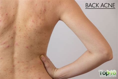 How To Get Rid Of Back Acne Top 10 Home Remedies Back Acne