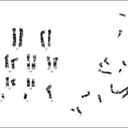 Conventional Cytogenetics Showing A Normal Karyotype On Gtg Banding