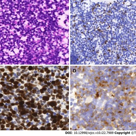 Histological And Immunohistochemical Images Of Merkel Cell Carcinoma