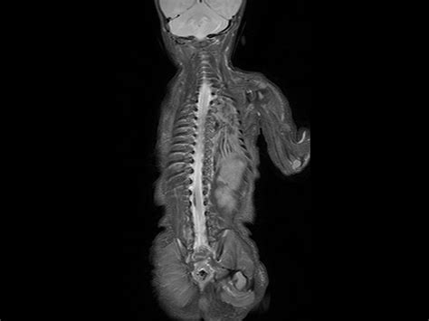 Pediatric Total Spine With Spina Bifida Philips Mr Body Map