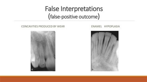 Radiographic Of Interpretation Of Dental Caries Ppt