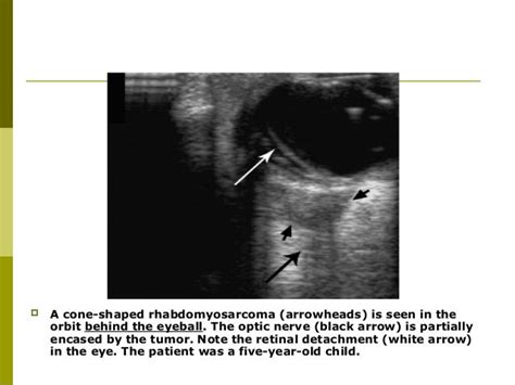 Eye ultrasound