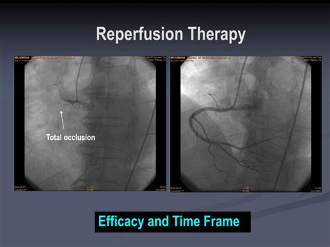 Ppt Treatment Of Stemi Mechanical Reperfusion Therapy Powerpoint