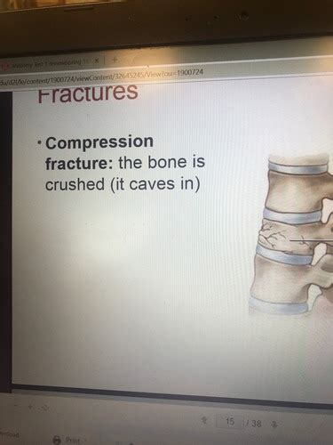 Bone Fractures Flashcards Quizlet