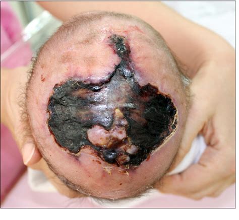 Figure 1 From Treatment Of Aplasia Cutis Congenita On Scalp Using