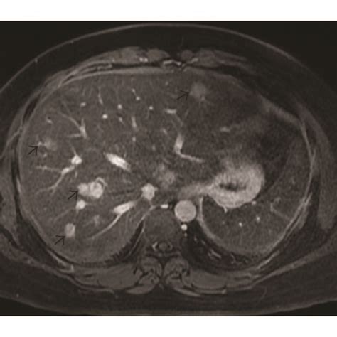 A B Baseline Mri A Axial T2 Weighted Fat Saturated T2w Fs Image Download Scientific