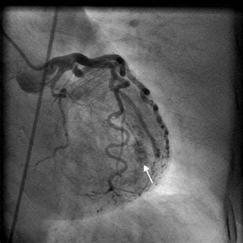 Coronary Angiogram In Left Anterior Oblique Cranial View Of The Left