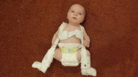 Hip Dysplasia Clicky Hips In Babies Hubpages