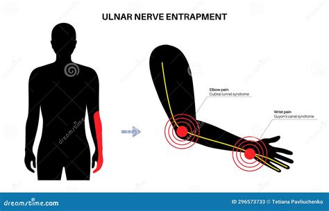 Ulnar Nerve Entrapment Stock Illustration Illustration Of Limb 296573733