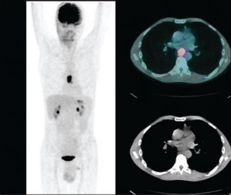 18f Fdg Petct Imaging In Oncology Annals Of Saudi Medicine