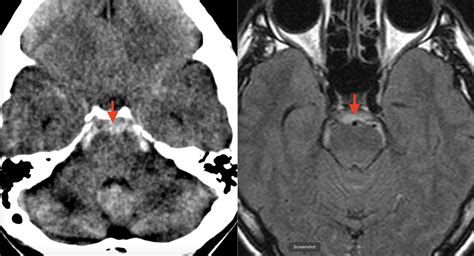 Perimesencephalic Non Aneurysmal Subarachnoid Haemorrhage Pnsah Eurorad