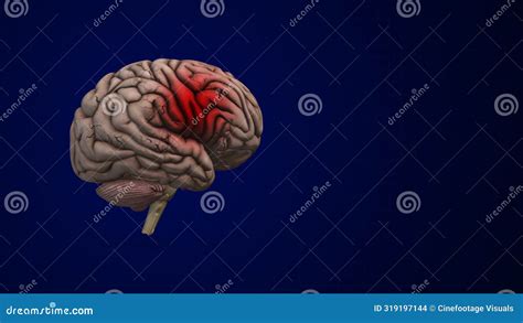 Brain Bleed Or An Intracranial Hemorrhage Illustration Megapixl